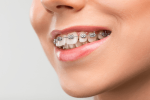 brackets