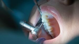 sensibilidad dental