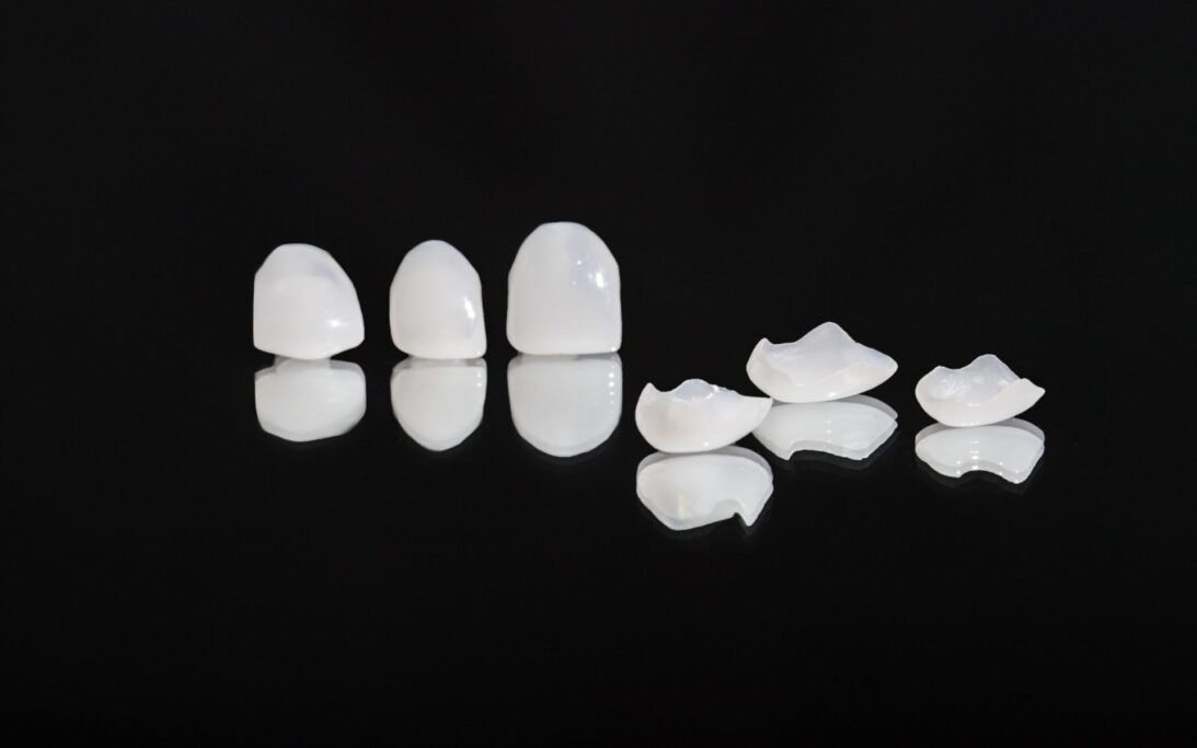 carillas dentales sin tallado