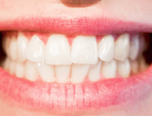 Cuando la mordida no encaja bien: cómo puede afectar al desgaste, la mandíbula y la salud dental