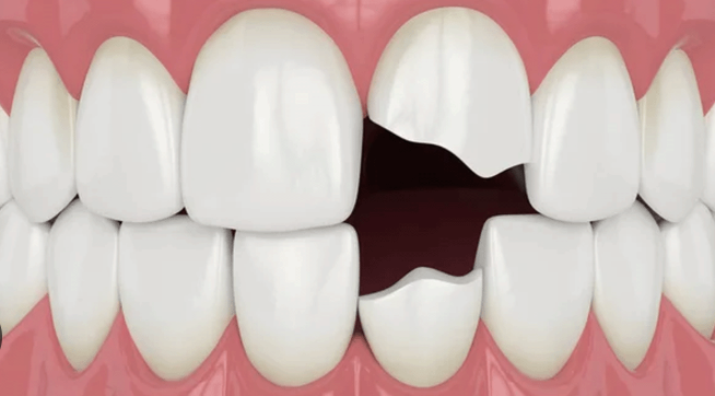 paciente revisando un diente roto en clínica dental