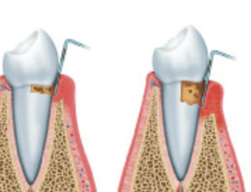 Análisis bacteriano periodontal: qué es y por qué puede cambiar el tratamiento de las encías