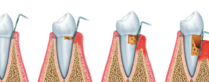 análisis bacteriano periodontal para detectar patógenos responsables de periodontitis