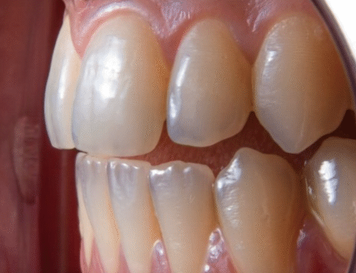 ¿Por qué aparecen manchas blancas en los dientes si no tengo caries?