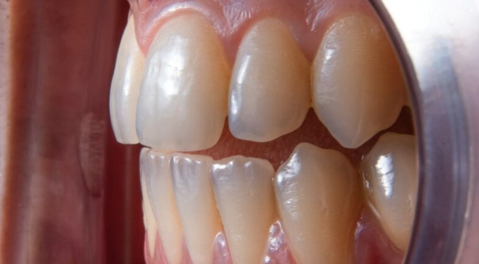persona observando transparencia en las puntas de los dientes delanteros