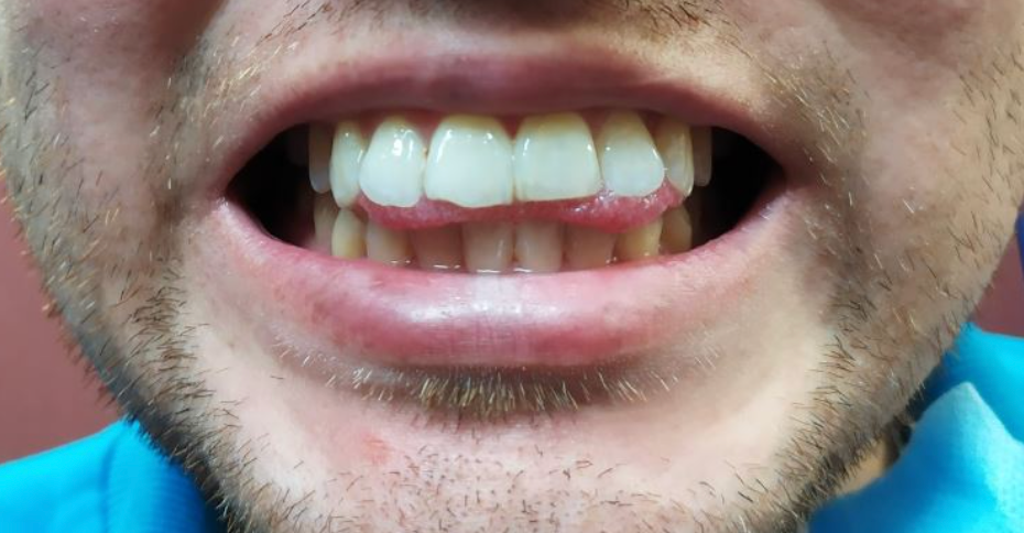 Lengua que empuja los dientes